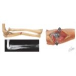 Fracture of the Ulna Shaft
