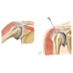 Shoulder Tendinitis and Bursitis