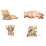 Fracture of Scaphoid