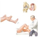 Rupture of the Anterior Cruciate Ligament