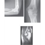 Imaging of the Elbow