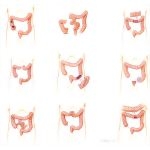 Abdominal Wounds of the Colon