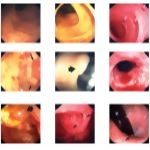 Anoscopic, Sigmoidoscopic, and Colonoscopic Views of Normal Intestinal Structures and Various Lesions