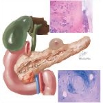 Chronic Pancreatitis