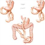 Complications of Bariatric Surgery