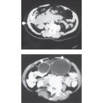 Complications of Acute Pancreatitis: CT Images of Necrosis and Pseudocysts