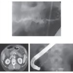 Chronic and Autoimmune Pancreatitis