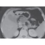 Cystic Tumors: Serous Cystadenoma of the Pancreas