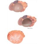 Cystic Tumors: Cystadenoma and Cystadenocarcinoma