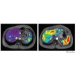 Magnetic Resonance Elastography to Stage Hepatic Fibrosis