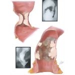 Malignant Lesion of Colon