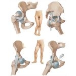 Disorders of Hip