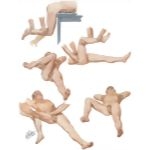 Disorders of Hip