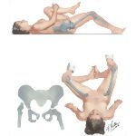 Disorders of Hip