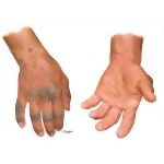 Allergic Contact Dermatitis