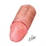 Balanitis - Herpes Progenitalis