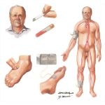 Clinical Evaluation of Patient With Diabetic Foot Lesion