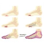 Wagner Classification of Diabetic Foot Lesion