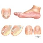 Clinical Examples of Onychomycoses: Distal and Lateral Subungual Onychomycosis