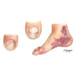 Clinical Examples of Onychomycoses: Proximal Subungual Onychomycosis and Proximal White Subungual Onychomycosis