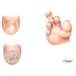 Clinical Examples of Onychomycosis