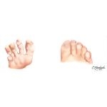 Prevention and Management of Onychomycosis