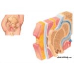 Evolution of a Pressure Ulcer: Late Superficial Ulceration