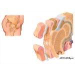 Evolution of a Pressure Ulcer: Late Deep Ulceration