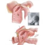 Gastrojejunocolic Fistula