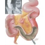 Regional Enteritis