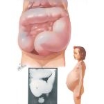 Megacolon