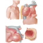 Surgery of Aorta