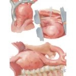 Surgery of Aorta
