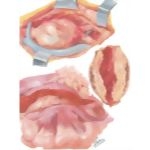 Surgery of Aorta