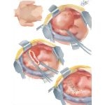 Surgery of Aorta