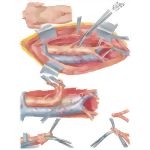 Surgery of Aorta