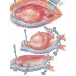 Surgery of Aorta