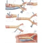 Surgery of Aorta