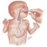 Emergency Surgery of Newborn