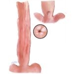 Esophagitis and Peptic Ulcer of Esophagus