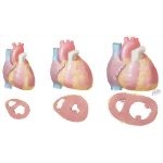 Normal Heart and Hypertensive Hearts