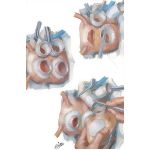 Operative Procedure