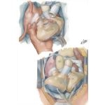 Operative Procedure