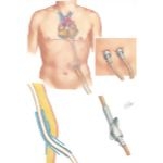 Emergence of the Tubes to the Pneumatic Heart Driver