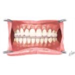 Wear of Occlusal Stabilization Splint