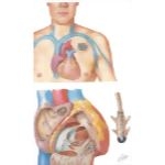 Dual Chamber Cardiac Pacemaker