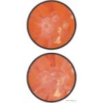 Hypertensive Retinopathy