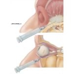 Methods of Anethesia and Akinesia for Cataract Surgery