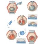 Cataracts Phacoemulsification and Insertion of Flexible IOL