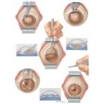 Cataracts Intracapsular Cataract Extraction and Insertion of IOL